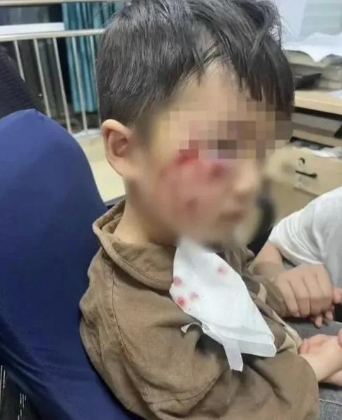 被瘋犬咬傷沒有“救命藥”，怎么辦？